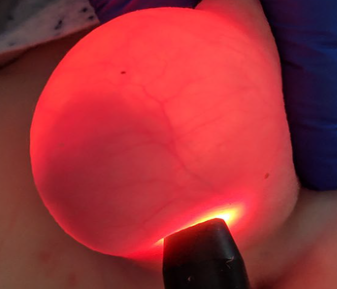 acute scrotal pain_transilluminable